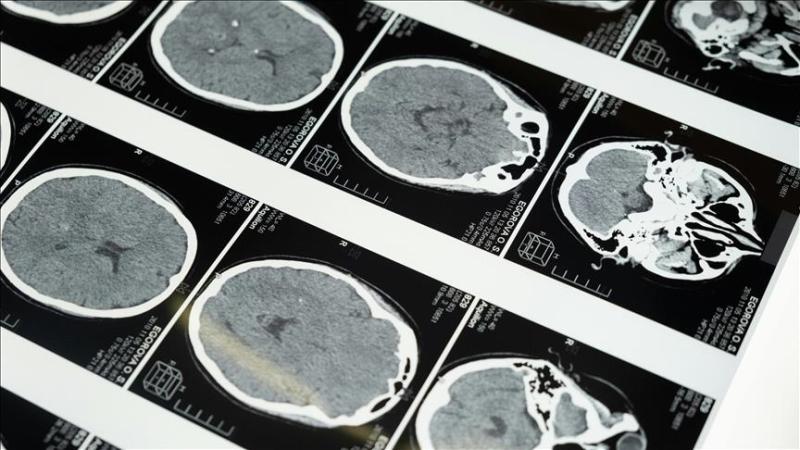 Uzmanlardan masajla gelen inme uyarısı